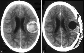Tumor lesion sizing — detail view 1