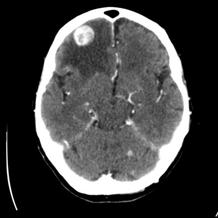 Tumor lesion sizing — detail view 2